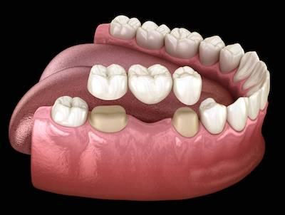 image of dental bridge at dentist in clayton nc