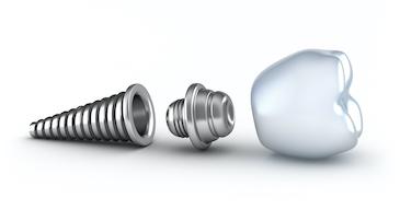 image of a dental implant in clayton nc