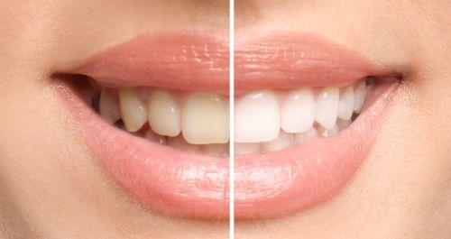 Ready for Whiter Teeth in Clayton, NC?