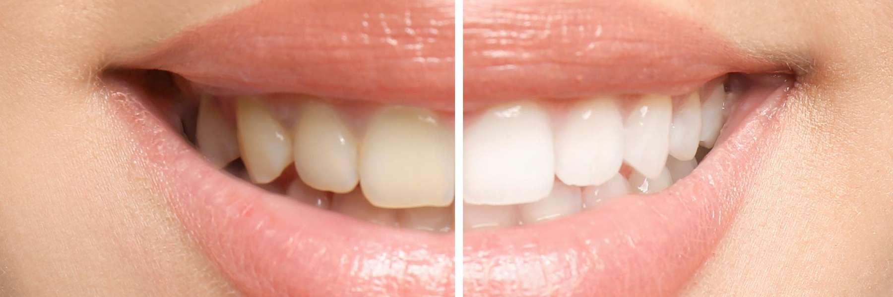 teeth whitening clayton nc
