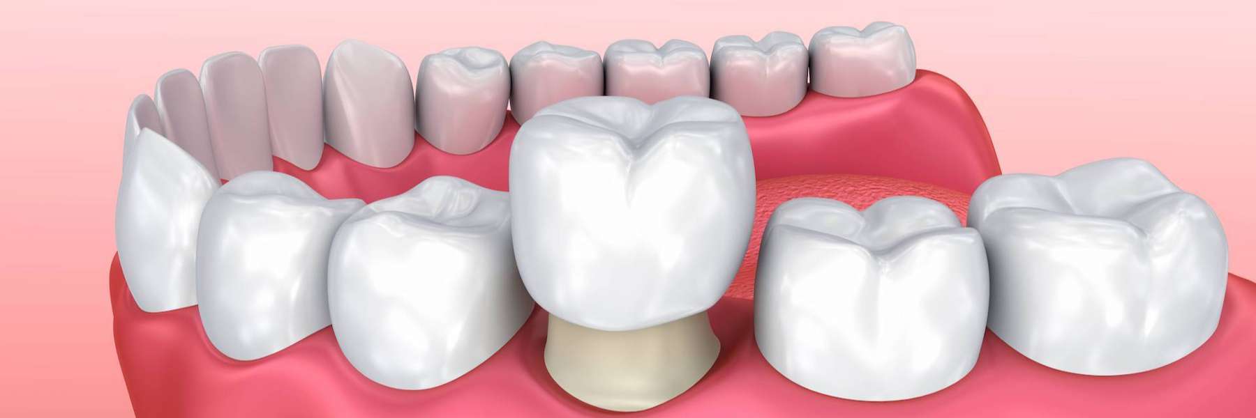 An illustration of Dental Crowns in Clayton, NC