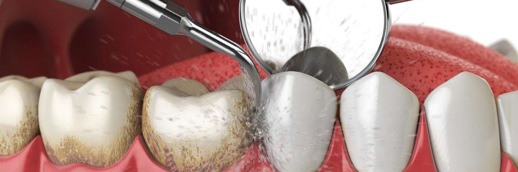 An illustration of a dental cleaning Services in West Clayton, NC