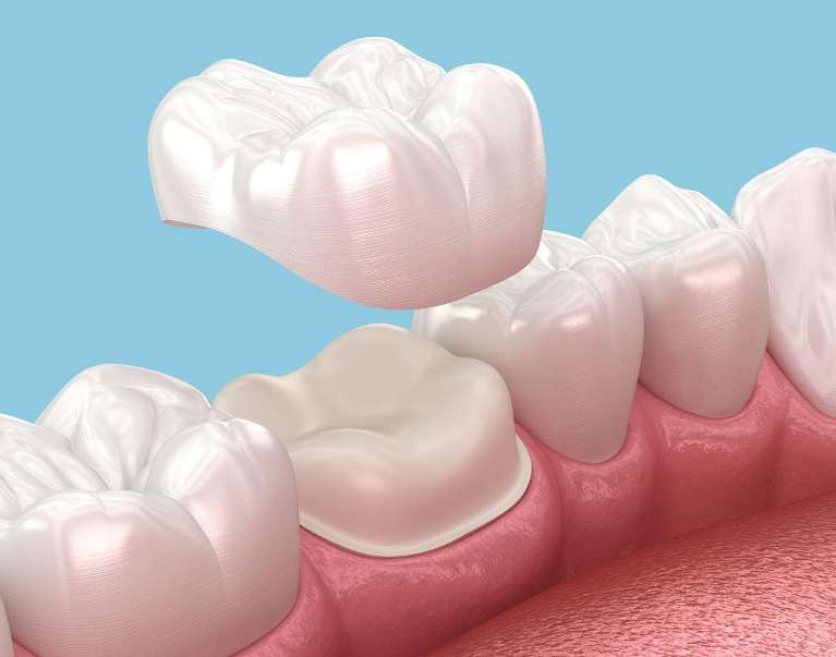 An image depicting dental crown in Clayton, NC