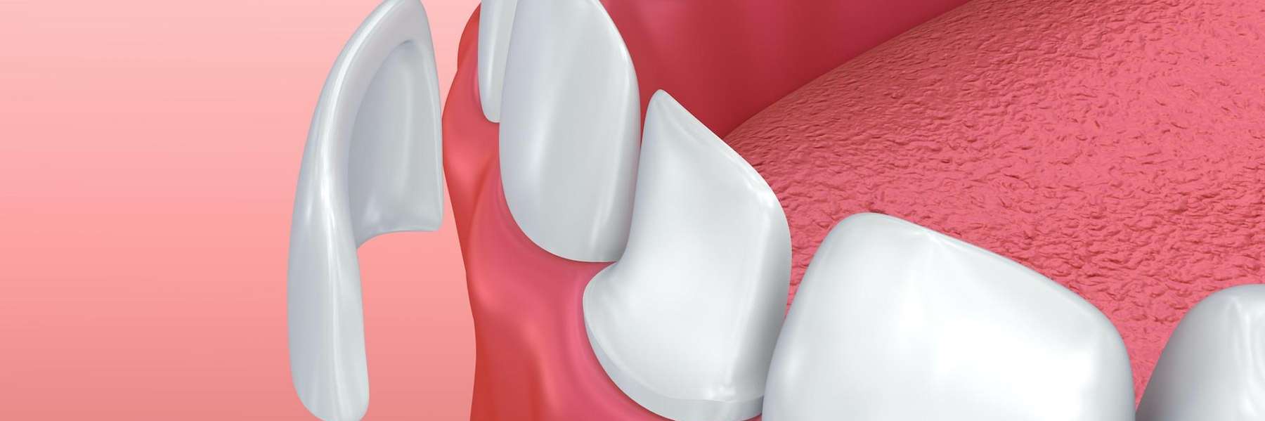 an illustration of a veneer from top-quality cosmetic dentist in Clayton, NC