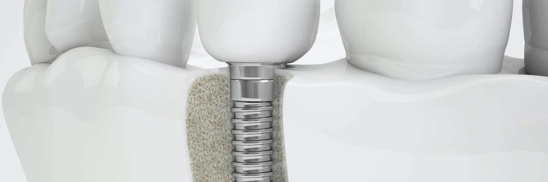 an illustration of a Dental Implant in West Clayton, NC