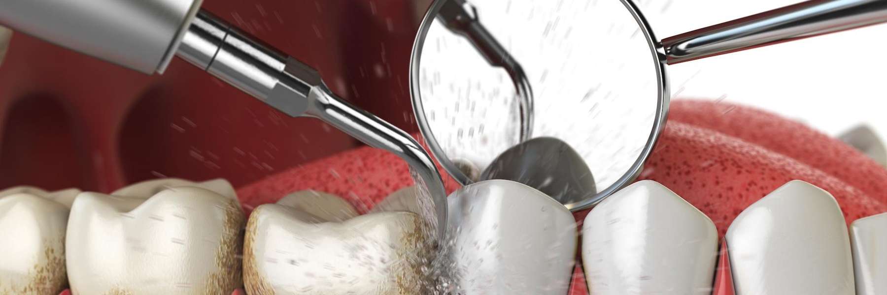An illustration of a dental cleaning Services in West Clayton, NC