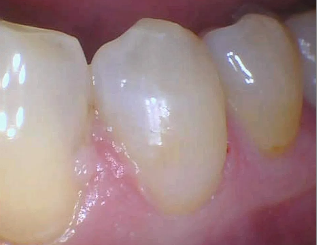 cavity side of molar