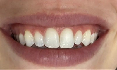 After picture of a patient before Non Invasive White Spot Treatment