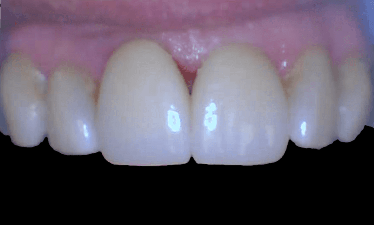 Repairing-Fractured-Teeth-with-Crowns-After-Image