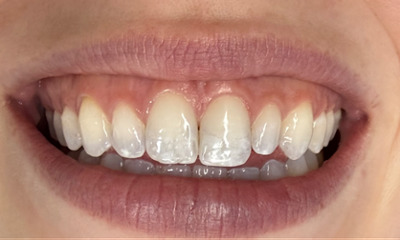 Before picture of a patient before Non Invasive White Spot Treatment