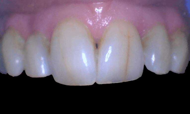 Repairing-Fractured-Teeth-with-Crowns-Before-Image